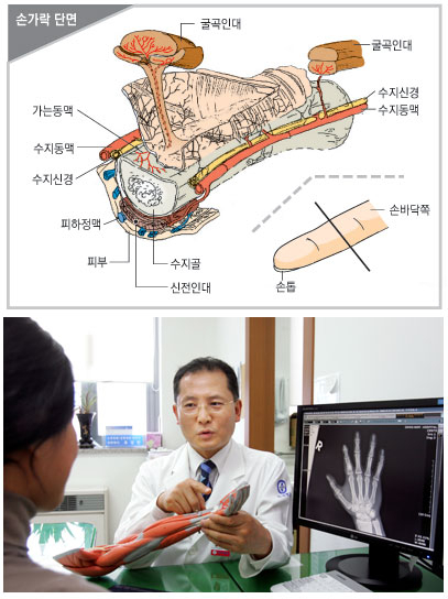 손은 인체의 다른 부위와 달리 복잡한 구조를 갖고 있어서 작은 손상에도 혈관, 신경, 인대 등이 손상돼 운동장애 등의 후유증이 생길 수 있다. 이상철기자 finder@msnet.co.kr