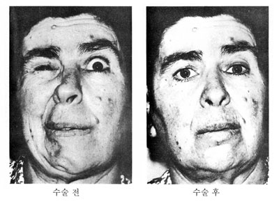 반측성 안면 경련은 자신의 의지와 관계없이 갑자기 얼굴에 경련이 일어나거나 얼굴 한쪽이 일그러지는 증상이다.