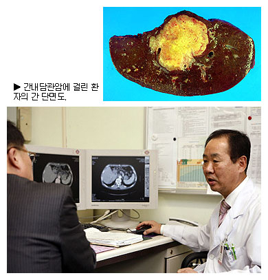 ▲ 김홍진 영남대병원 교수가 간내담관암 CT 검사 결과를 보며 환자와 상담을 하고 있다.