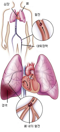 폐색전증은 다리 부위 정맥의 혈전이 떨어져 폐동맥을 막아 발생하는 질환으로, 심하면 숨질 수도 있기 때문에 미리 예방하고 빨리 증상을 파악해 치료받는 게 좋다.