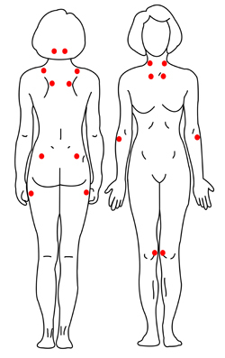 섬유근통 환자의 18개 압통점
