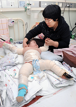 피부가 썩어가는 병에 걸린 혜인이(5·여)이는 다섯 살 아이가 감당하기에는 너무 힘든 고통을 받고 있다. 정운철기자woon@msnet.co.kr