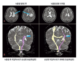 그림1=발병 후 2주가 지나서 촬영한 뇌 MRI. 왼쪽 피질척수로가 뇌출혈에 의하여 끊겨 있는 상태(화살표)였다가 10개월 후 회복된 모습을 보이고 있다.