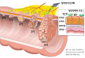 대장 내시경을 통해 조기에 대장암을 찾아내면 생존율은 0기 100%, 2기 80%까지 높아진다.