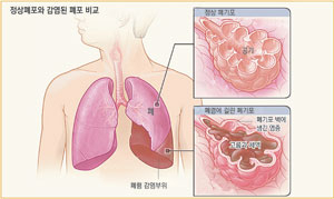 폐렴을 앓고 있는 환자의 X-선 폐 사진. 오른쪽 아래 부분 하얗게 보이는 부분이 폐렴 부위다.