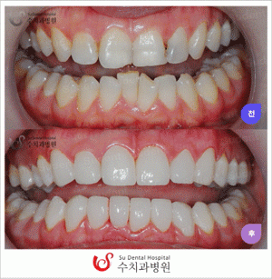 라미네이트는 시술 시 치아 일부를 삭제한 후 진행되기 때문에 이에 대한 부작용 혹은 치아건강을 걱정하는 사람들이 많다. 치아가 많이 삭제될 경우 상아질이 노출되어 이시림현상이 지속되거나 라미네이트를 한 앞니로 음식을 먹다가 떨어지거나 깨지는 현상이 일어날 수도 있다. 이러한 부작용은 개인의 치아상태를 제대로 확인하지 않은 채 삭제를 너무 많이 가했을 경우 일어날 수 있다.