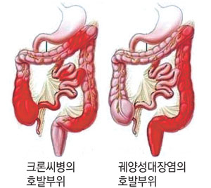 궤양성 대장염 환자의 대장내시경. 표면이 거칠어 보이며 불규칙한 모양의 궤양이 있다.