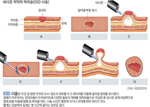 위의 일부나 전체를 잘라내는 위암 수술에 비해 