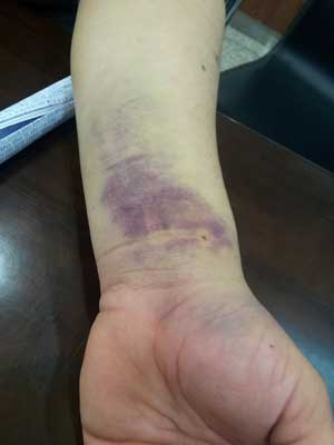 동맥 혈액 추출 후 수일이 지난 6일 현재까지 A씨의 팔은 멍자국과 상처가 뚜렷하게 남아 있다.