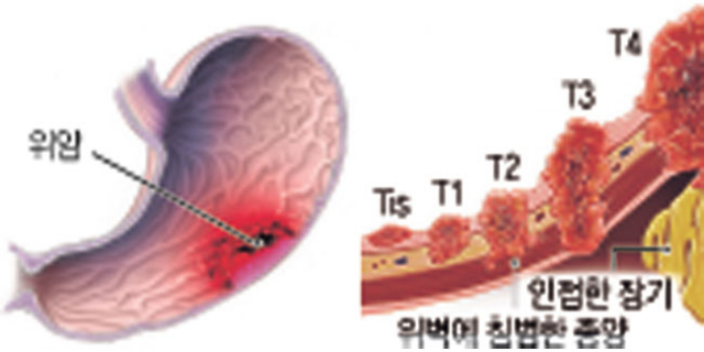 위점막에 생긴 암 덩어리가 점차 위벽으로 확산되고 있는 모습.