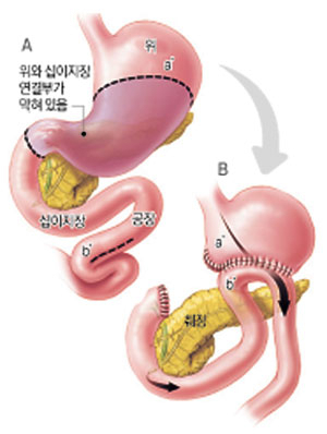 위공장문합술-위의 일부를 잘라낸 뒤 남는 위가 작아서 십이지장까지 당겨지지 않을 때, 십이지장 아래에 있는 공장(空腸)을 끌어서 위와 연결한다. 이런 수술을 