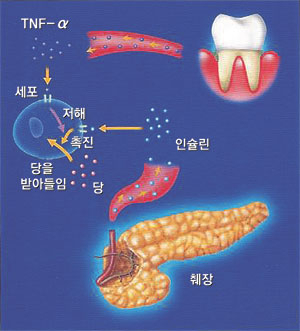 치주질환이 있으면 염증 때문에 특정 물질이 분비되는데 이는 세포가 당을 흡수해 소화하는 것을 방해한다. 이때문에 혈당량이 높아져 당뇨 조절에 실패하게 된다.