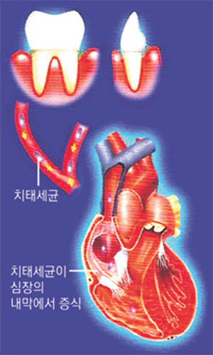 치태(프라그)에 있는 수많은 세균이 혈관을 타고 심장으로 이동해서 증식하면 심내막염을 일으킬 수도 있다.