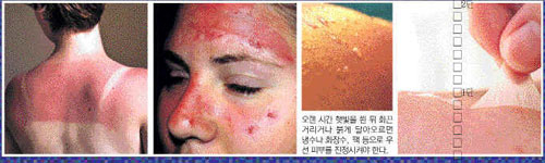 오랜 시간 햇빛을 쬔 뒤 화끈거리거나 붉게 달아오르면 냉수나 화장수, 팩 등으로 우선 피부를 진정시켜야 한다.