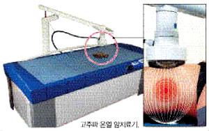 고주파 온열 암치료기 모습.