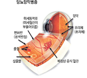 당뇨 합병증의 하나인 당뇨망막병증은 실명을 일으킬 수 있는 심각한 질환이다. 혈당을 조절하더라도 당뇨망막병증이 올 수 있는 만큼 꾸준한 정기검진을 통해 눈 상태를 점검해야 한다.