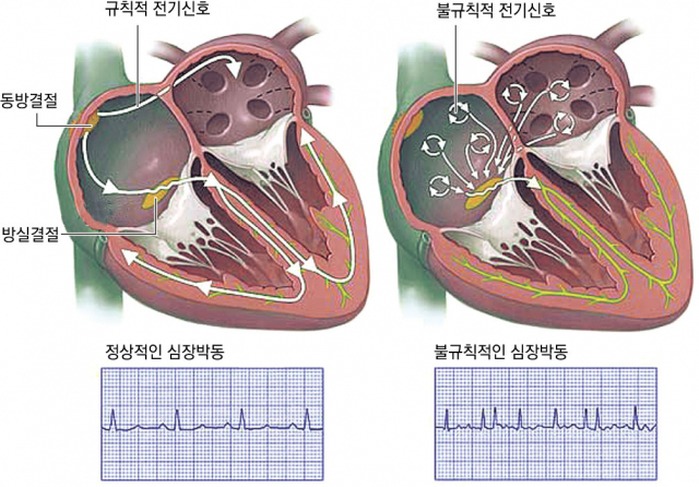 우심방 위쪽 동방결절에서만 전기신호가 발생해서 심장이 규칙적으로 뛰는 모습(왼쪽). 심방 곳곳에서 전기신호가 발생하고 그 신호가 방실결절로 이어져 심장이 훨씬 빨리 뛰는 모습(오른쪽).