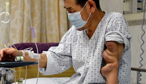 만성신부전증에 시달리다 신장이식 수술을 받은 박동희(51) 씨. 생명은 건졌지만, 병원비 걱정에다 17년간 혈액 투석 후유증으로 혈관이 부어 올라 고통스러워 하고 있다. 김태형기자 thkim21@msnet.co.kr