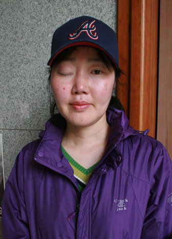 임미숙 씨는 뇌종양으로 치료를 제대로 받지 못해 오른쪽 눈의 시력을 잃어 버렸다. 신동우기자