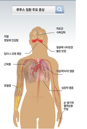 면역체계 이상으로 생기는 루푸스 질환은 온도
