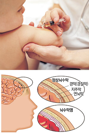매년 봄·여름철에 유행하는 바이러스성 뇌수막염은 모든 소아청소년 연령층에서 나타난다. 한편 올 3월부터 뇌수막염 백신접종은 국가예방접종사업에 포함돼 무료가 됐다.