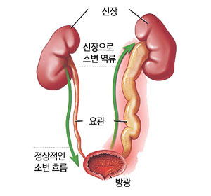 소아용 복강경을 이용한 방광요관역류 수술은 방광을 절개하는 것이 아니므로 혈뇨가 적고, 수술 후 소변 보는 데 문제가 없으며, 수술 후 흉터가 거의 남지 않기 때문에 미용적으로도 우수하다.