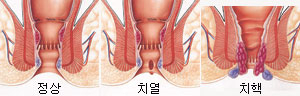 만성 변비를 치료하지 않고 방치하면 치열이나 치질 등의 원인이 될 수 있다.