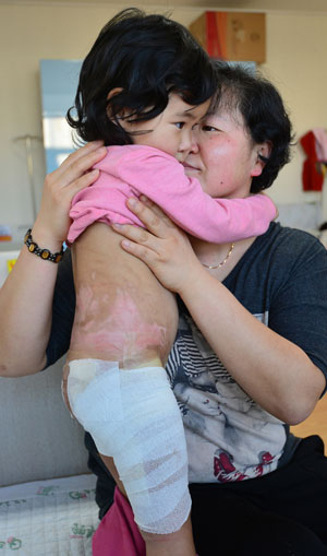 집에서 펄펄 끓고 있던 물을 뒤집어쓴 아현이의 배와 허리, 엉덩이, 허벅지 등은 벌건 화상 상처투성이다. 아이의 몸에도 엄마의 마음에도 큰 상처가 생겼다. 정운철 기자 woon@msnet.co.kr