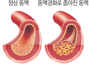 동맥경화가 진행된 혈관 모습.
