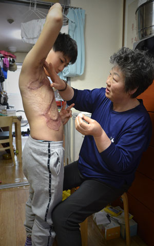 양우성(왼쪽) 군 할머니 최차남 씨가 우성이 상반신의 화상 흉터에 약을 발라주고 있다. 우태욱 기자 woo@msnet.co.kr