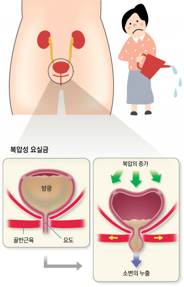 요실금은 다양한 원인에 의해 여러 형태로 나타난다. 증상이 의심스러울 때 비뇨기과 전문의를 찾아 정확한 진단과 치료를 받아야 건강한 노년을 보낼 수 있다. 경북대병원 제공