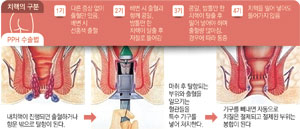 구병원 대장항문과 정진식 부원장이 수술을 하고 있다.