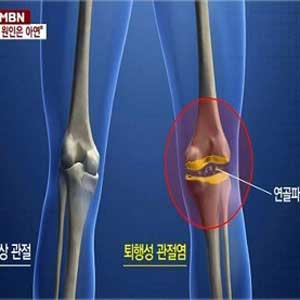 퇴행성관절염 예방법 사진. MBN 뉴스캡처