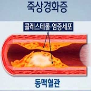죽상경화증 예방법 사진. SBS 뉴스캡처