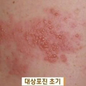 대상포진 예방법 사진. KBS 방송캡처