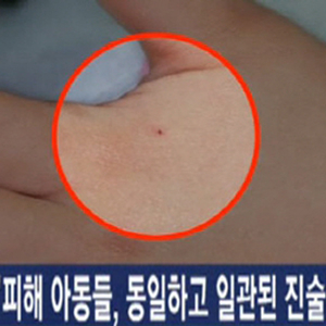 어린이집 바늘 학대 사진. JTBC 뉴스캡처