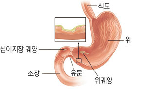 위궤양은 헬리코박터균이나 장기간에 걸친 약물 복용, 스트레스 등 다양한 원인에 의해 발생한다.