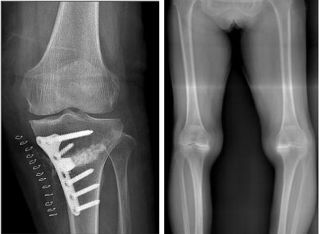 O자형 다리(왼쪽)의 내반교정술 X-ray 사진