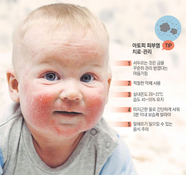 아토피 피부염은 만성적이고 재발하는 염증성 피부 질환으로 유아기나 소아기에 시작되는 게 보통이다. 미세먼지와 황사가 사람들을 괴롭히는 봄, 아토피 피부염 증상을 가진 어린이라면 더 고생하기 마련이다.매일신문DB