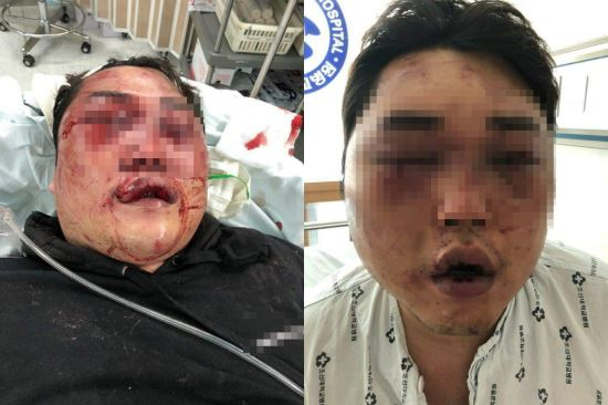 지난달 30일 광주에서 일어난 집단 폭행사건으로 피해자 A씨가 심각한 부상을 입은 모습. 온라인 커뮤니티 캡처