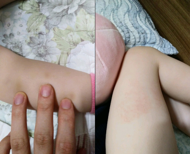 대구 달서구 이곡동 한 어린이집 보육교사가 3세 원아를 학대한 것으로 의심된다는 신고가 접수돼 경찰이 수사에 나섰다. 원아의 아버지 김모(가명) 씨는 아이 종아리와 허벅지에 각각 멍과 붉은 자국이 생겼다고 주장했다. 김 씨 제공