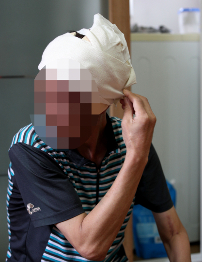 5년째 혈관암 투병 중인 류경호(가명·47) 씨가 머리를 감싼 붕대를 풀고 있다. 류 씨의 두피에서는 피고름 배어나오고 마약성 진통제를 먹어야 정도로 심한 통증에 시달린다. 김영진 기자 kyjmaeil@msnet.co.kr