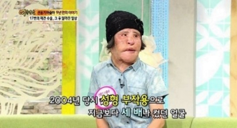 불법 성형 부작용으로 얼굴이 크게 부풀어 
