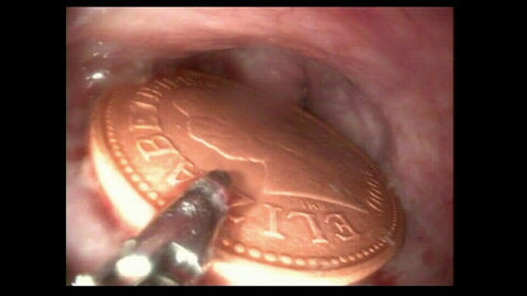 내시경으로 위 내 이물(동전)을 제거했다.(출처: ock endoscopy centre)