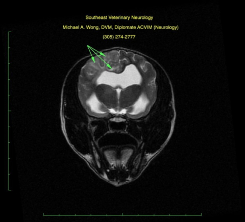 경련(발작)의 원인 중 하나인 뇌염(MRI) (이미지출처: https://www.sevneurology.com/)