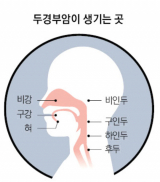 수술 후 재발 없이 깨끗한 좌측성대.