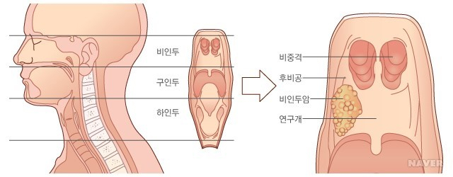 배우 구본임이 비인두암으로 세상을 떠나 안타까움을 주고 있다. 비인두암은 배우 김우빈이 앓으면서 세간에 널리 알려졌다. 서울대학교 의학정보