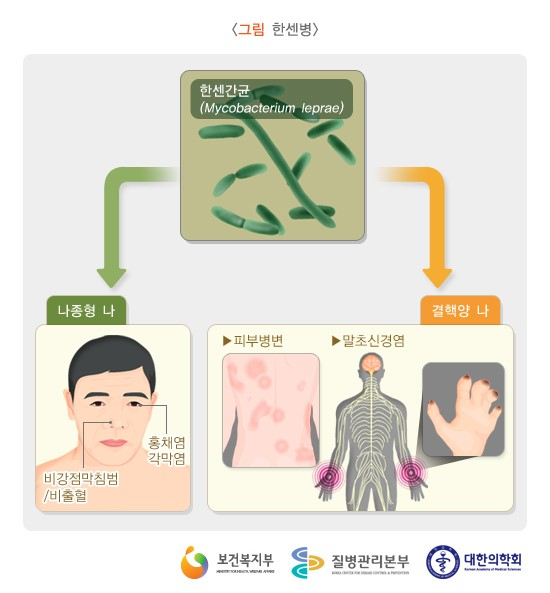 한센병 감염 및 증상. 질병관리본부 제공.