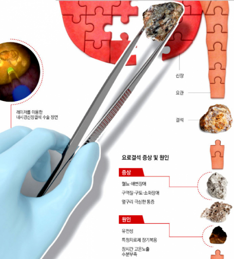 연성요관내시경을 이용한 신장결석 수술