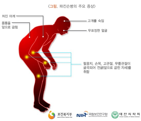 파킨슨병의 증상. 출처 보건복지부